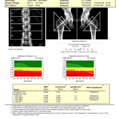 What do the numbers on a DEXA scan actually mean?